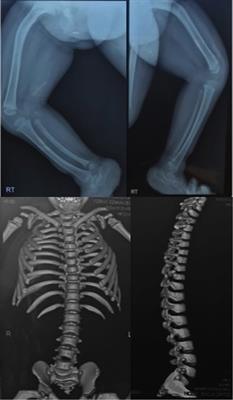 Novel SRY-box transcription factor 9 variant in campomelic dysplasia and the location of missense and nonsense variants along the protein domains: A case report